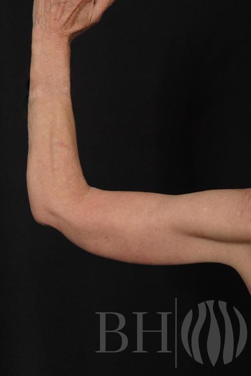 A close-up photo of an older person's bent arm showing loose, crepey skin on the upper arm and elbow area, likely a before or after photo for a cosmetic or medical procedure. The 'BH' wordmark logo with a flame-like icon is watermarked in the lower center