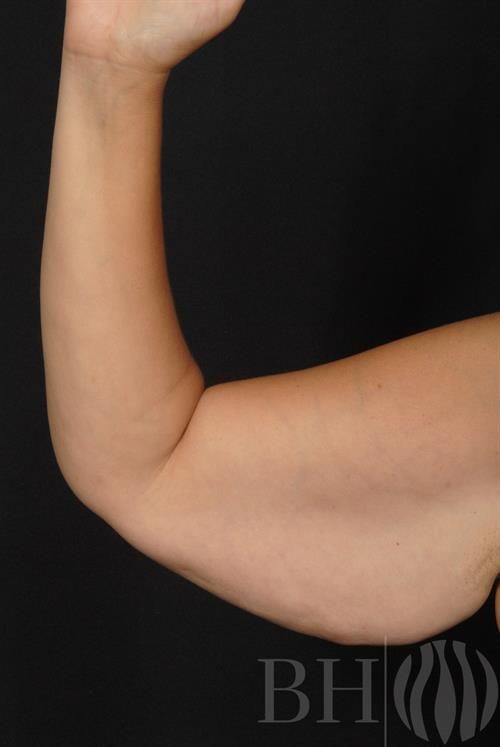 A close-up clinical photo of a person's bent arm showing the upper arm and elbow area, with a 'BH' watermark logo in the lower right corner.