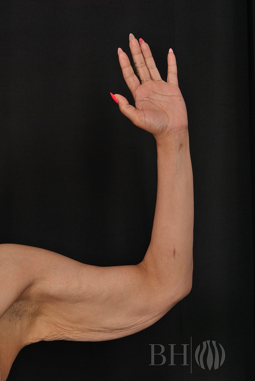 A close-up clinical photo of a woman's raised arm showing the inner and outer arm contour, with red manicured nails visible on her raised hand, featuring the BH logo watermark in the lower right corner.