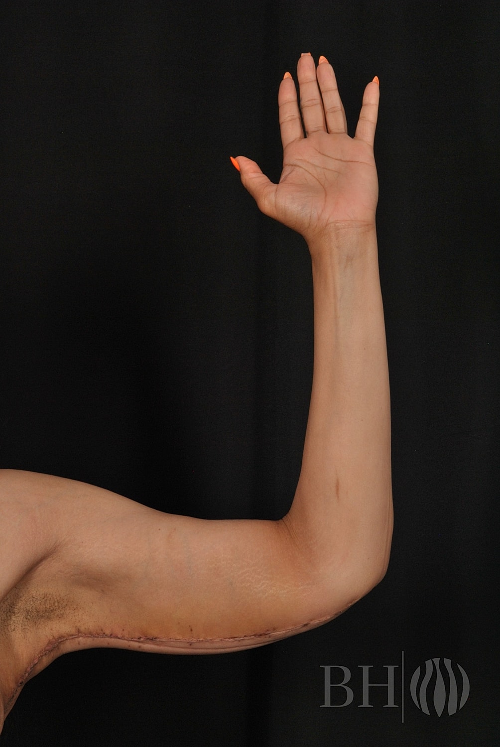 A raised arm showing the inner side, with a visible surgical scar along the upper arm (brachioplasty/arm lift result), orange painted fingernails, and a 'BH' logo watermark in the lower right corner.