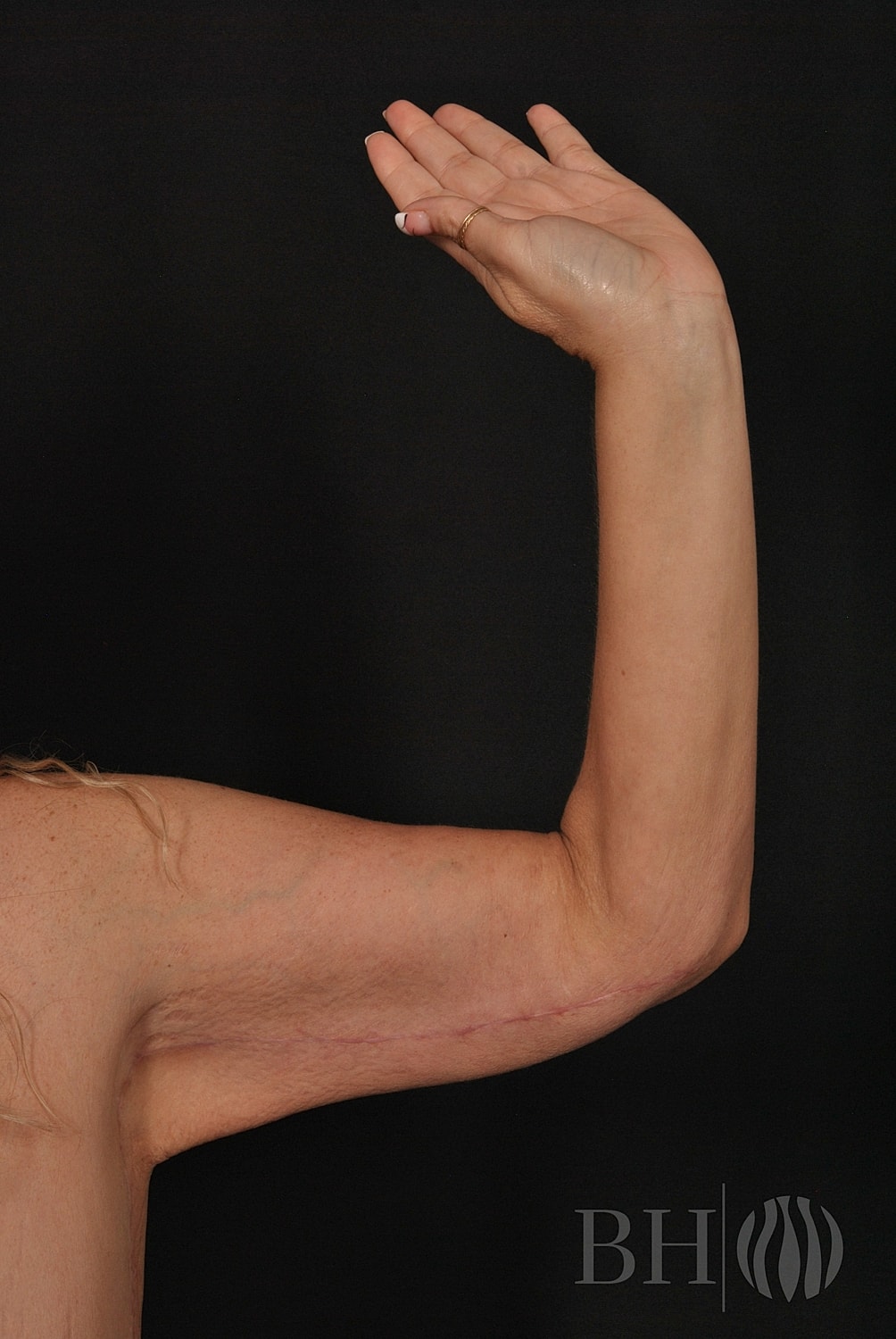 Close-up clinical photo of a woman's raised arm showing the inner upper arm area with a visible surgical scar along the tricep region, likely a brachioplasty (arm lift) result, with a gold ring on one finger. A 'BH' watermark logo with a flame-like icon