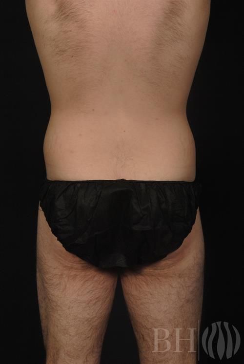 Rear view of a male patient's torso and upper legs, wearing black disposable briefs, showing the back, lower back, and buttocks area, a before or after photo watermarked with the 'BH' logo.