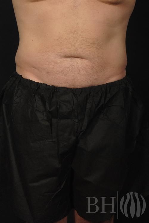 Front-view clinical photo of a woman's torso and upper legs after mommy makeover surgery, showing improved body contour. A 'BH' logo watermark is in the lower right corner.