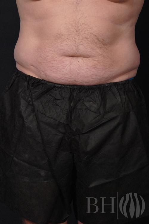 Front-view clinical photo of a woman's torso and upper legs, showing the abdomen, hips, and upper thighs before a mommy makeover procedure. A 'BH' logo watermark with a flame icon is in the lower right corner.