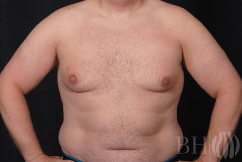 Front-view clinical photo of a woman's torso showing breast and abdominal area before surgery, with the 'BH' logo watermark in the lower right corner.