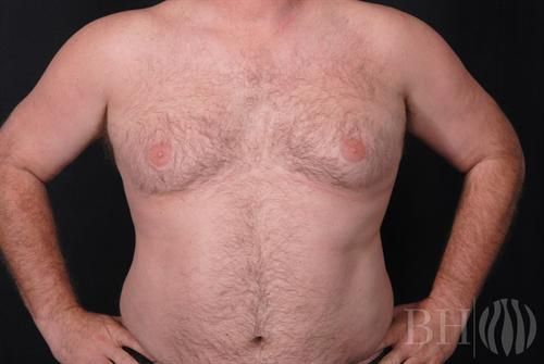 Front-view clinical photo of a woman's torso showing breast revision results, with the BH logo watermark in the lower right corner.