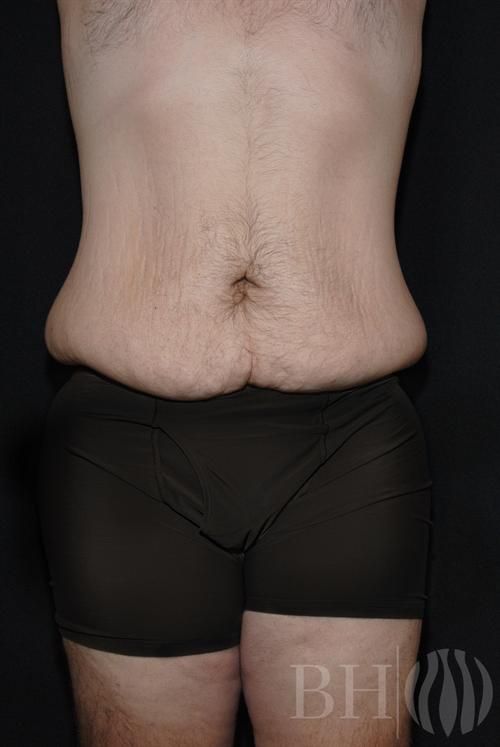 Close-up clinical photo of a male chest showing enlarged, gynecomastic breast tissue with a 'BH' watermark logo in the lower right corner.