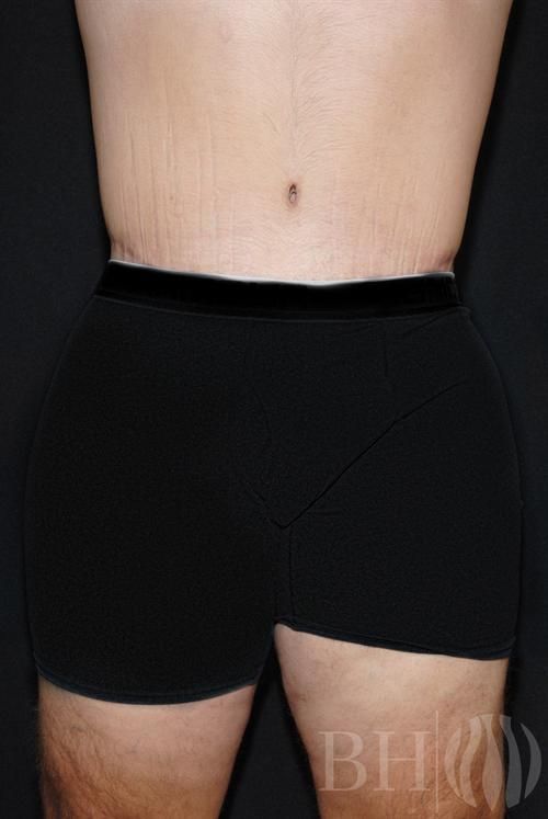 Close-up clinical photo of a male chest after gynecomastia reduction surgery, showing a flatter, more defined pectoral area, with a 'BH' logo watermark in the lower right corner.