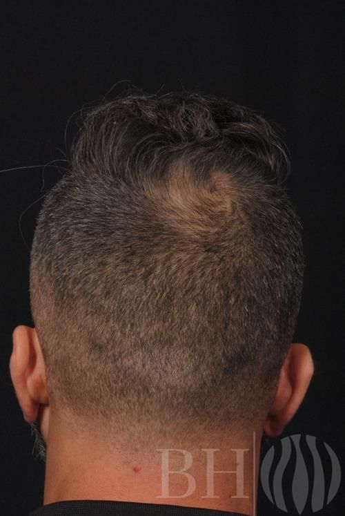 Back view of a man's head showing a hair transplant donor area with shaved short hair, featuring the 'BH' logo watermark in the lower right corner.