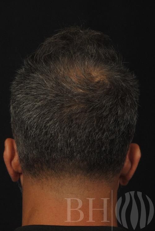 Rear view of a man's head showing short dark hair with some thinning at the crown, in a clinical hair restoration before-and-after photo. The 'BH' logo watermark is visible in the lower right corner.