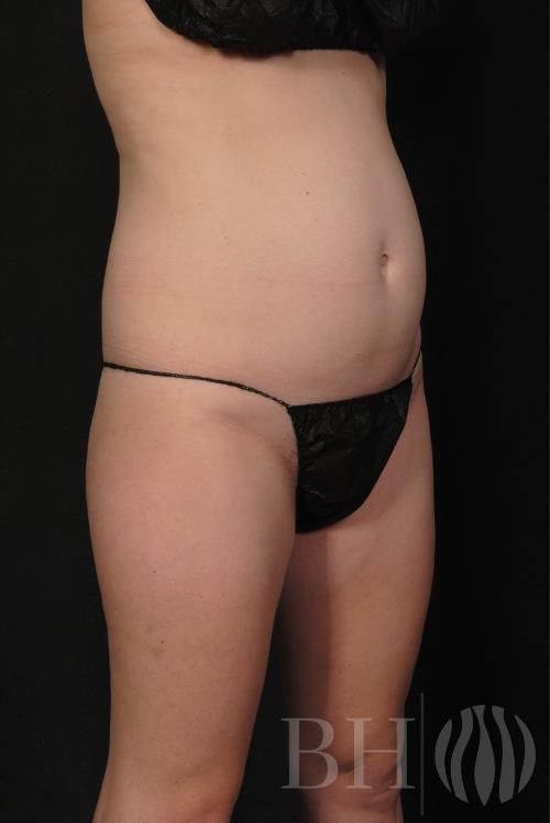 A clinical before photo showing a woman's midsection and hips in a black bikini, taken at an oblique angle, featuring the BH logo watermark in the bottom right corner.