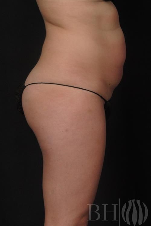 Side profile view of a person's midsection, abdomen, and upper thigh area wearing a black bikini bottom, with the 'BH' logo watermark visible in the lower right corner.