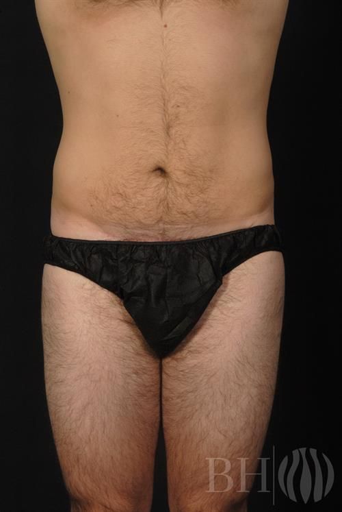 Front view of a male torso and upper thighs, showing the abdomen and leg contour after a body contouring procedure. A 'BH' logo watermark with a flame icon is visible in the lower right corner.