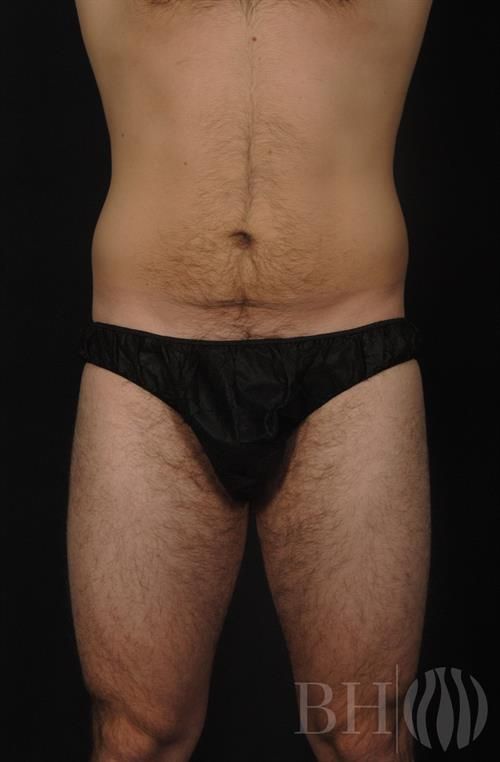 Front view clinical photo of a male torso and upper thighs, wearing black briefs, showing the abdomen and leg contour. A 'BH' logo watermark with a flame icon is visible in the lower right corner.