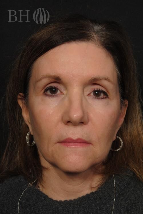 Front-facing clinical portrait of a middle-aged woman with shoulder-length dark brown hair, brown eyes, and silver hoop earrings wearing a dark top and a thin necklace. The letters 'BH' with a wave icon logo watermark appear in the upper left corner.