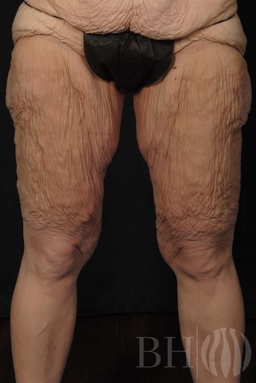 Rear view of a person's lower body showing the backs of both thighs and legs with significant skin laxity and wrinkling, wearing black underwear, with the 'BH' logo watermark in the lower right corner.