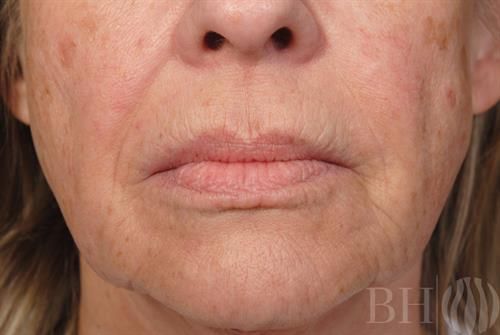 Close-up of the lower face of an older woman showing the mouth, lips, nasolabial folds, and surrounding skin with visible fine lines and age spots, with a 'BH' watermark logo in the bottom-right corner.
