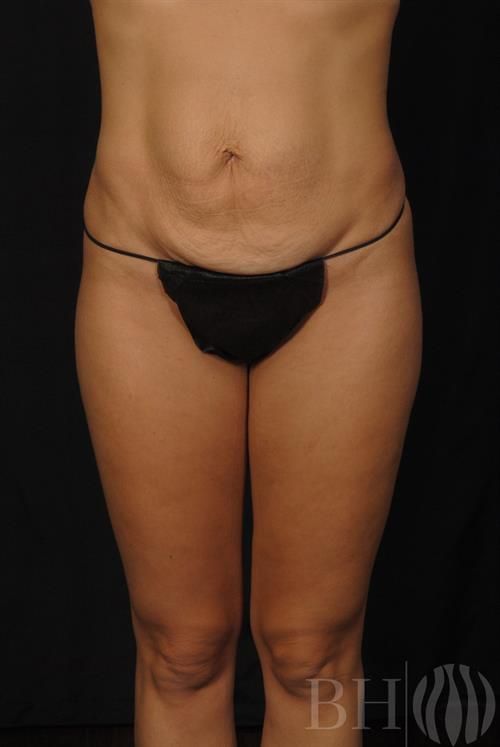 Front-view clinical before photo of a person's midsection and upper thighs, wearing black bikini underwear, showing the abdomen and leg contour, with the BH logo watermark in the bottom right corner.