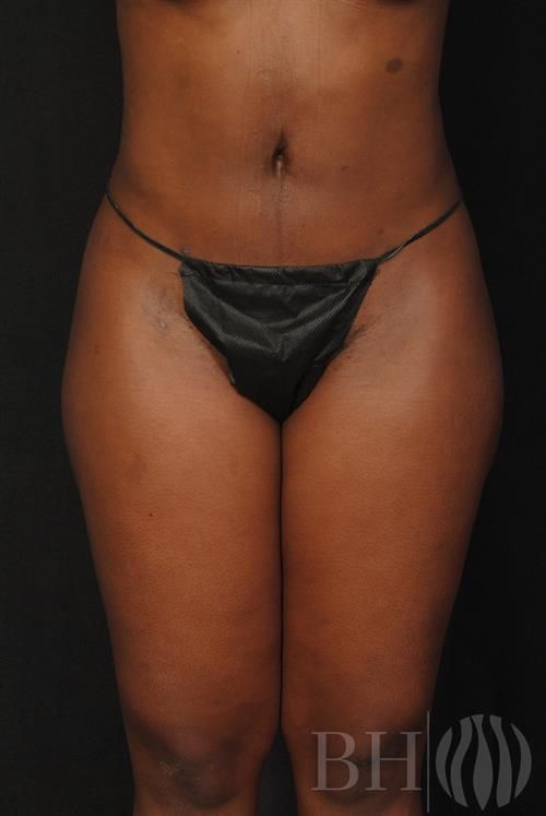 A clinical before-and-after photo showing the front view of a patient's midsection and upper thighs, wearing a black bikini undergarment, with the 'BH' watermark logo in the lower right corner, typical of a cosmetic surgery or body contouring medical