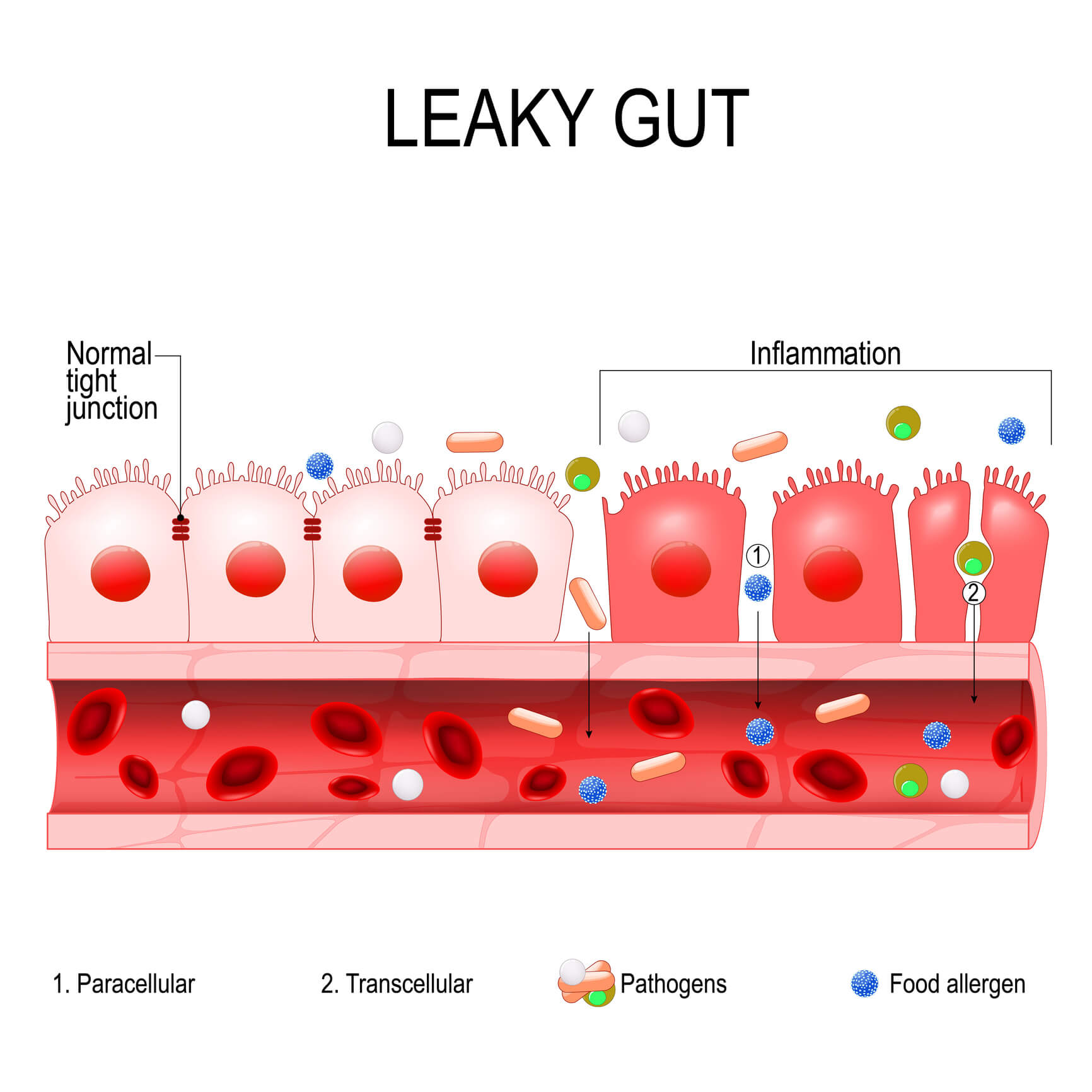 Intestinal barrier and leaky gut