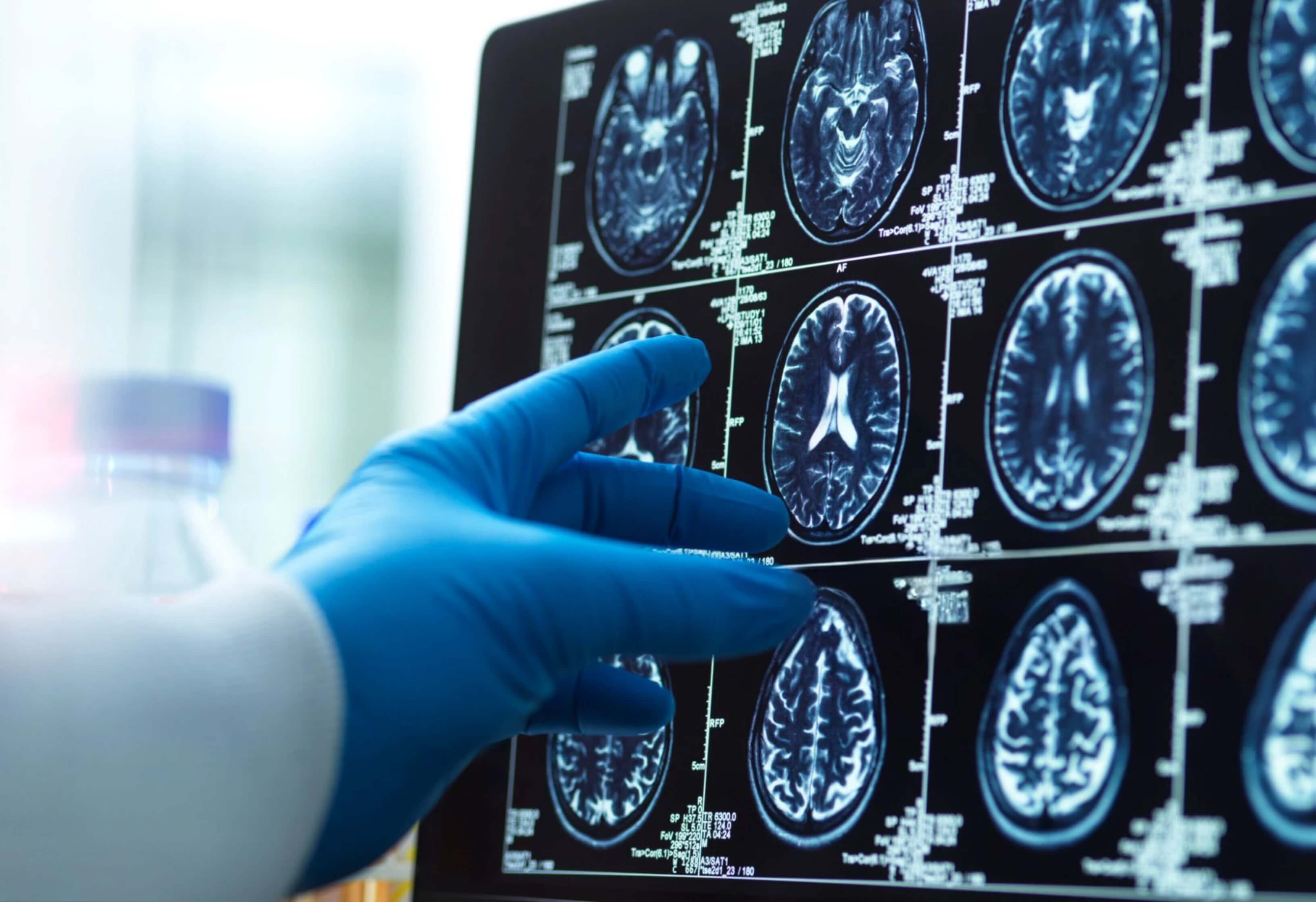 Brain MRI showing developmental change