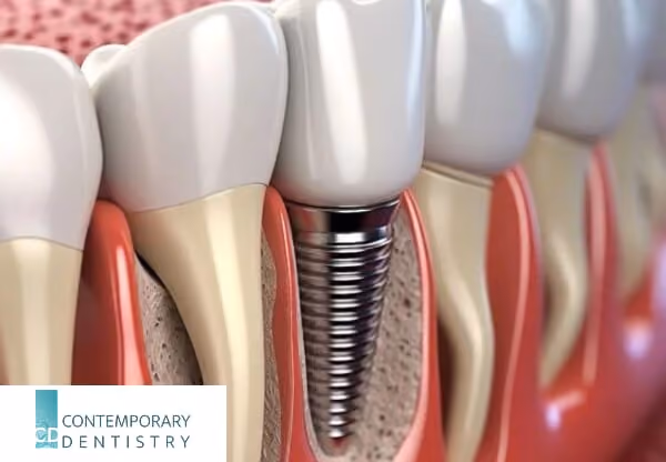 Close-up illustration of a dental implant showing the titanium screw placed in the jawbone supporting a dental crown.