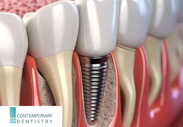 Close-up illustration of a dental implant showing the titanium screw placed in the jawbone supporting a dental crown.