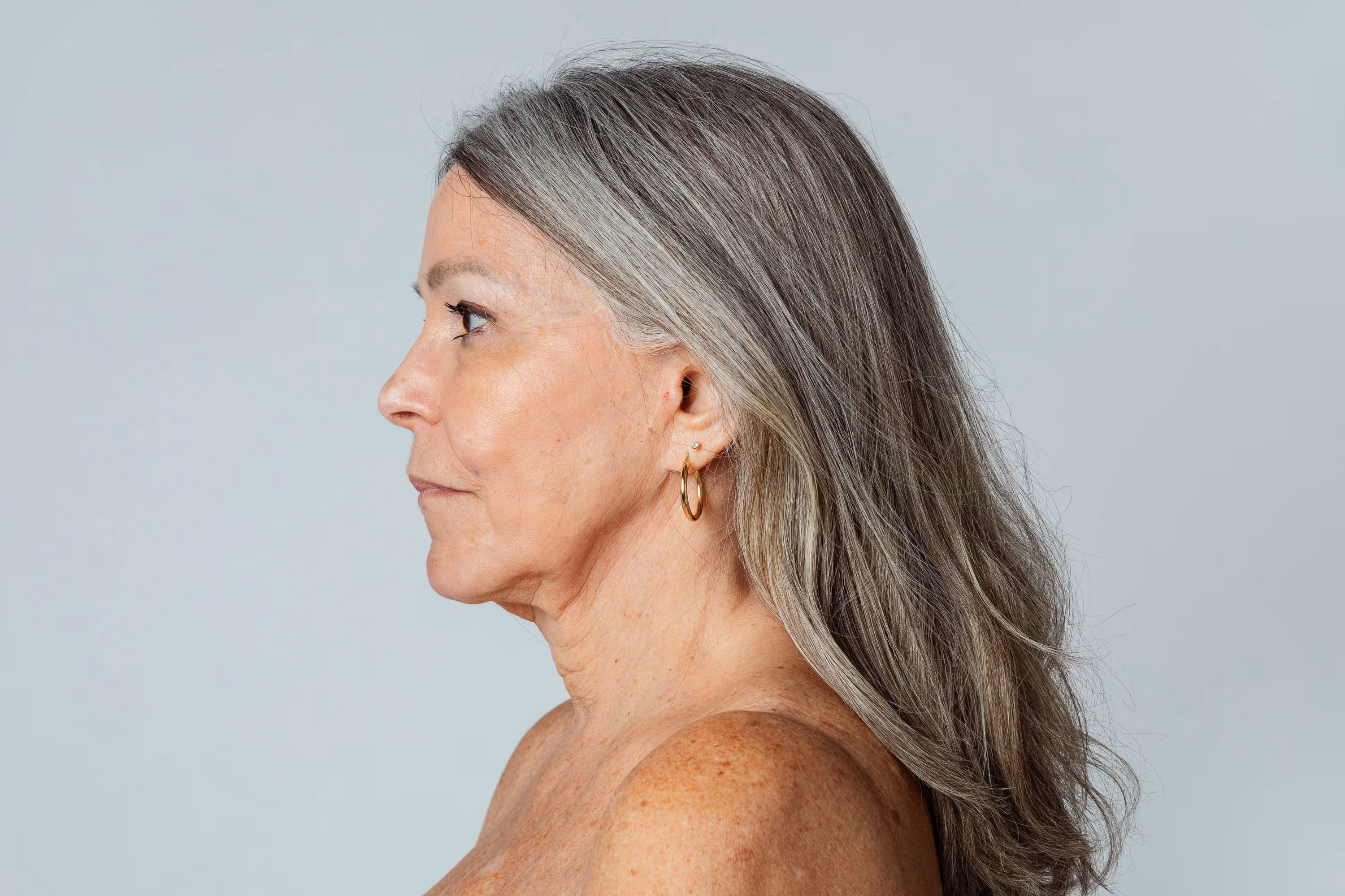 Defined jawline and neck contour after chin liposuction, the result patients in Minneapolis and St. Paul ask about most