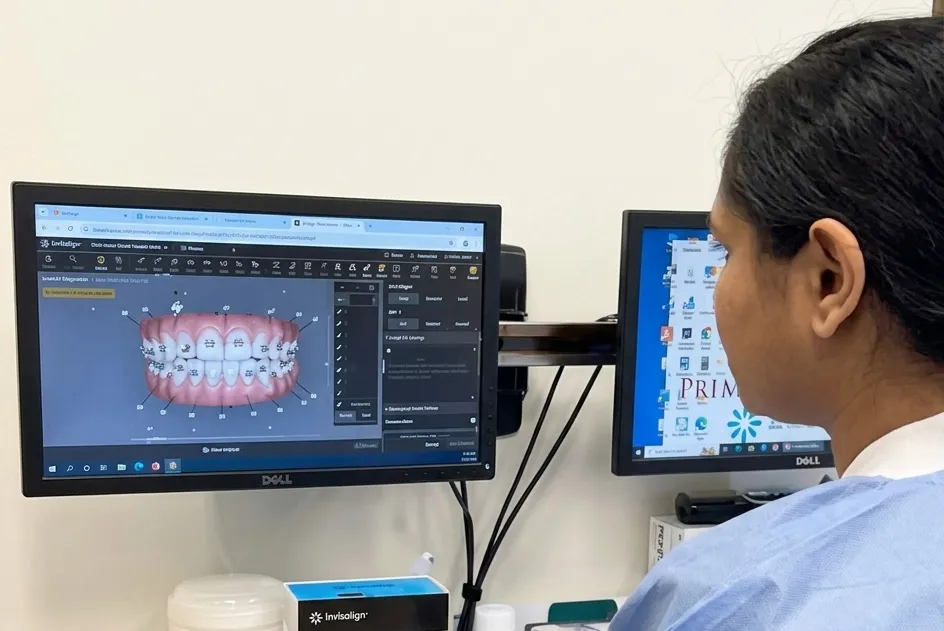 Veneers