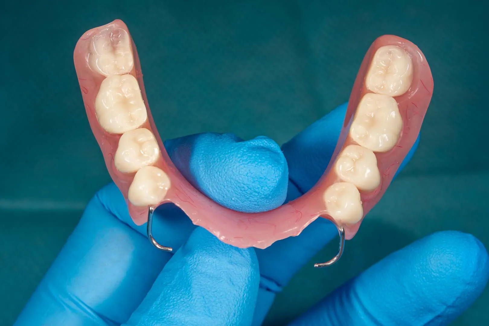 Gloved hand holding a partial denture with six artificial molars and metal clasps.