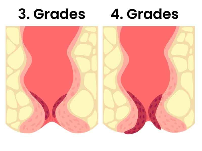 so sehen hämorrhoiden in der schwangerschaft 4. und 4. grades aus