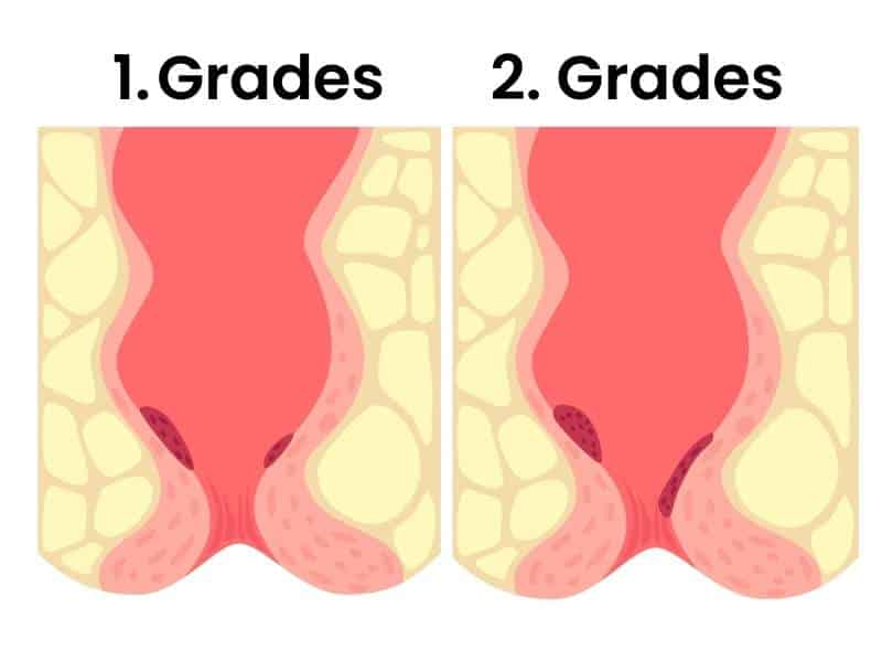 hämorrhoiden ersten und zweiten grades in der schwangerschaft