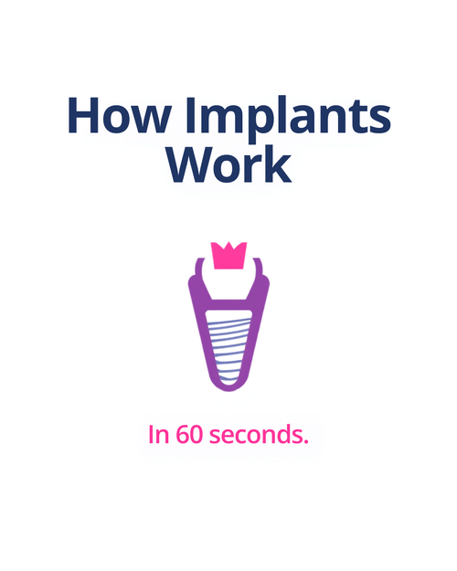 Post explaining how dental implants work