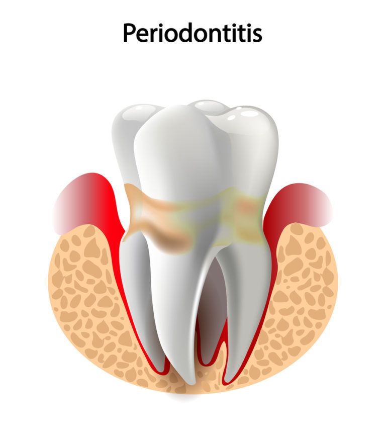 Periodontal Care