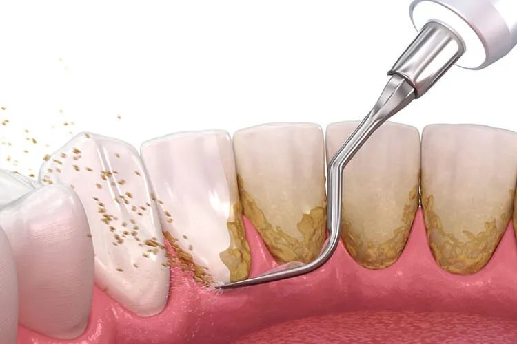 Teeth Cleaning