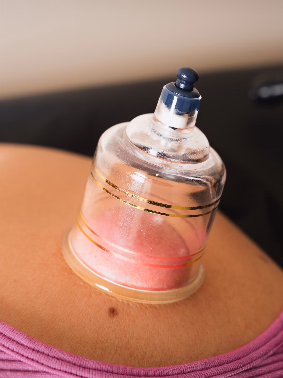Ventosa de vidrio aplicada en la piel para terapia de succión.