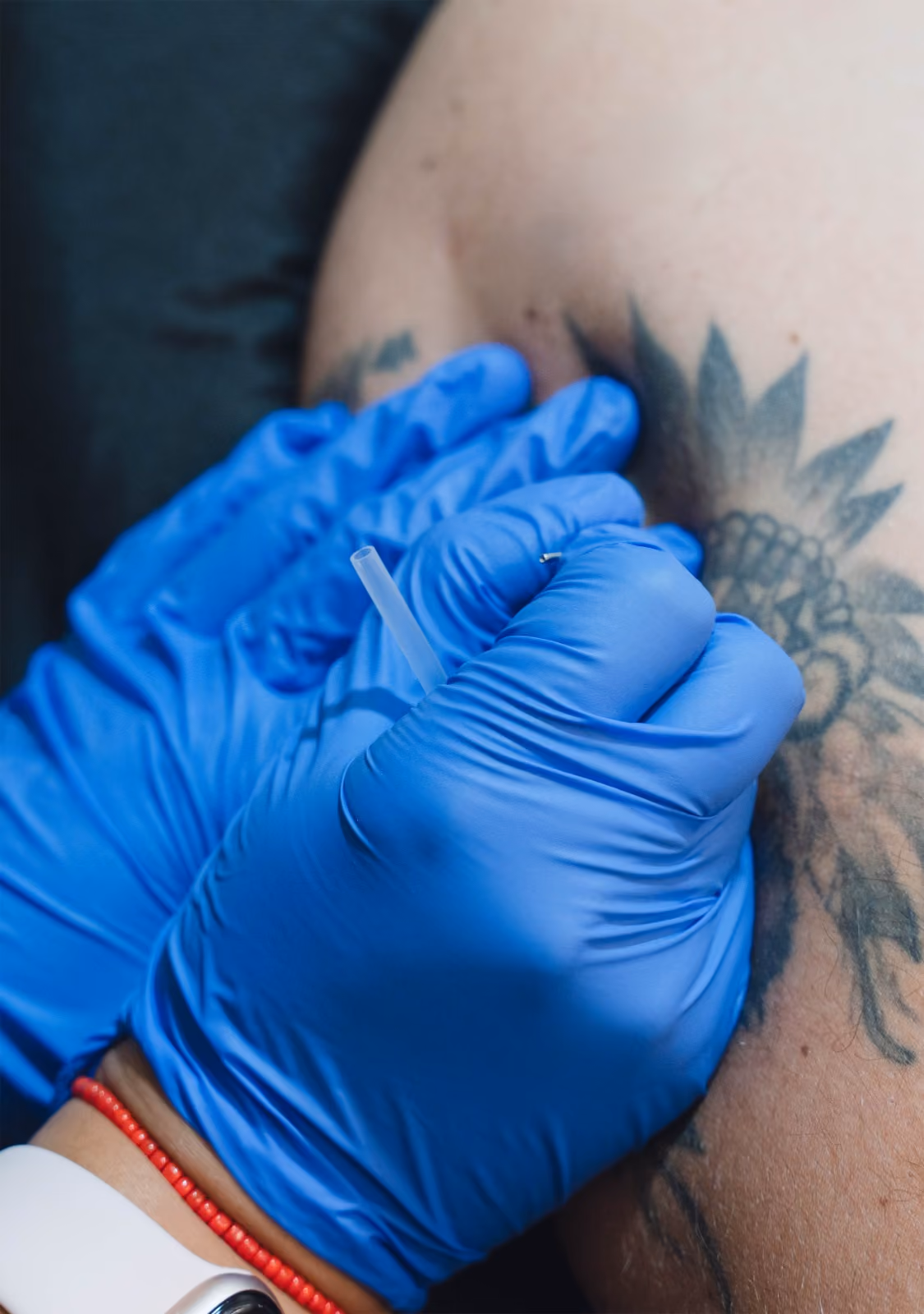 Mano con guantes azules aplicando agujas muy finas
