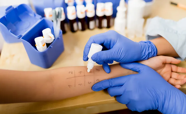 Skin-prick allergy testing on a patient's forearm