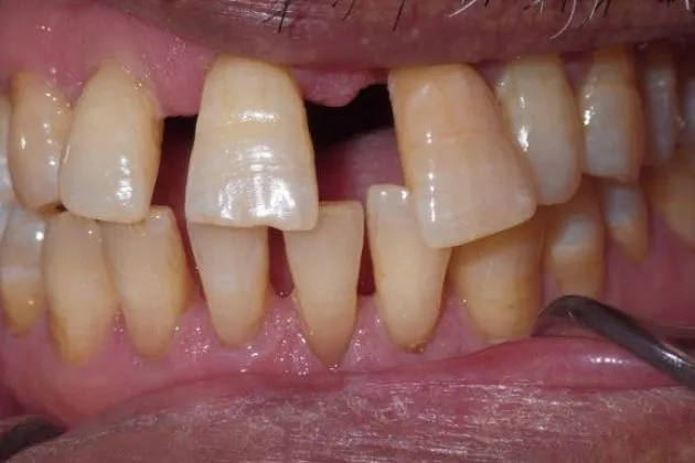 Before and after dental bridges showing replacement of missing and damaged upper teeth