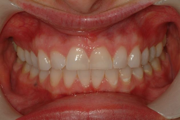Before and after porcelain veneers showing corrected spacing and shape of upper and lower teeth