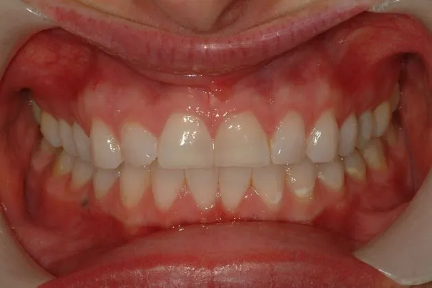 Before and after porcelain veneers showing corrected spacing and shape of upper and lower teeth