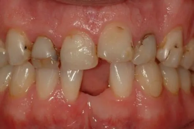 Before and after composite bonding showing repaired chipping and discoloration on upper front teeth