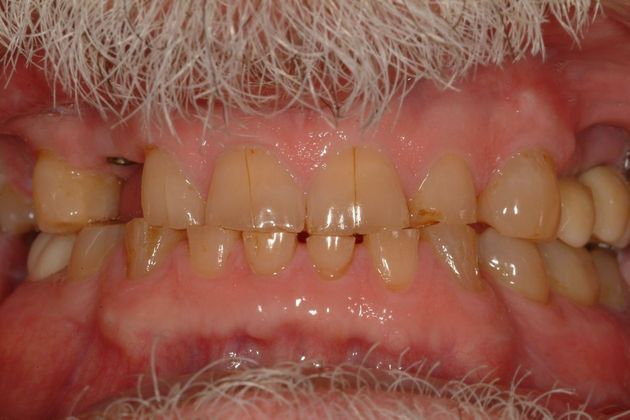 Before and after full mouth reconstruction showing restored teeth replacing damaged and missing teeth