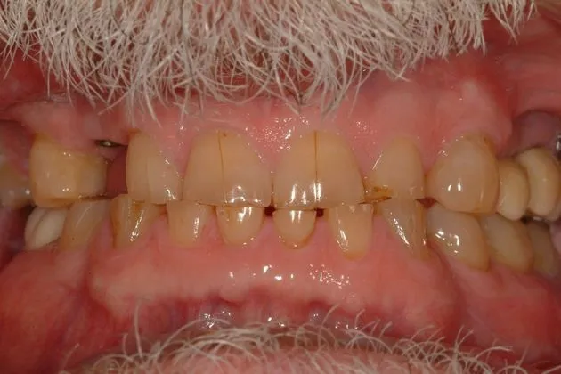 Before and after full mouth reconstruction showing restored teeth replacing damaged and missing teeth