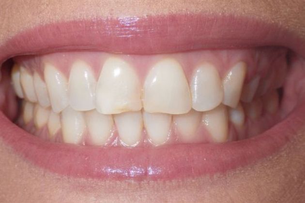 Before and after composite bonding showing improved alignment and appearance of upper front teeth