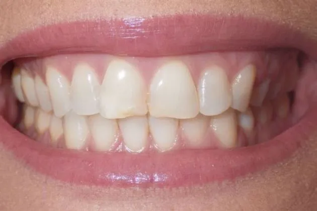 Before and after composite bonding showing improved alignment and appearance of upper front teeth