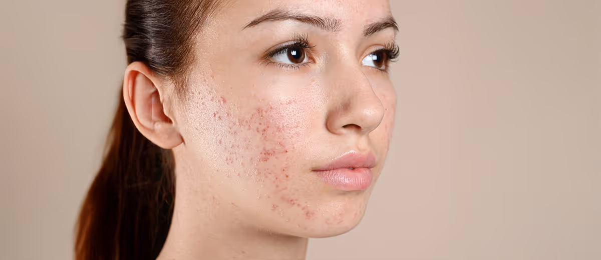 Primer plano del rostro de una mujer joven con acné visible en la mejilla derecha, fondo beige.