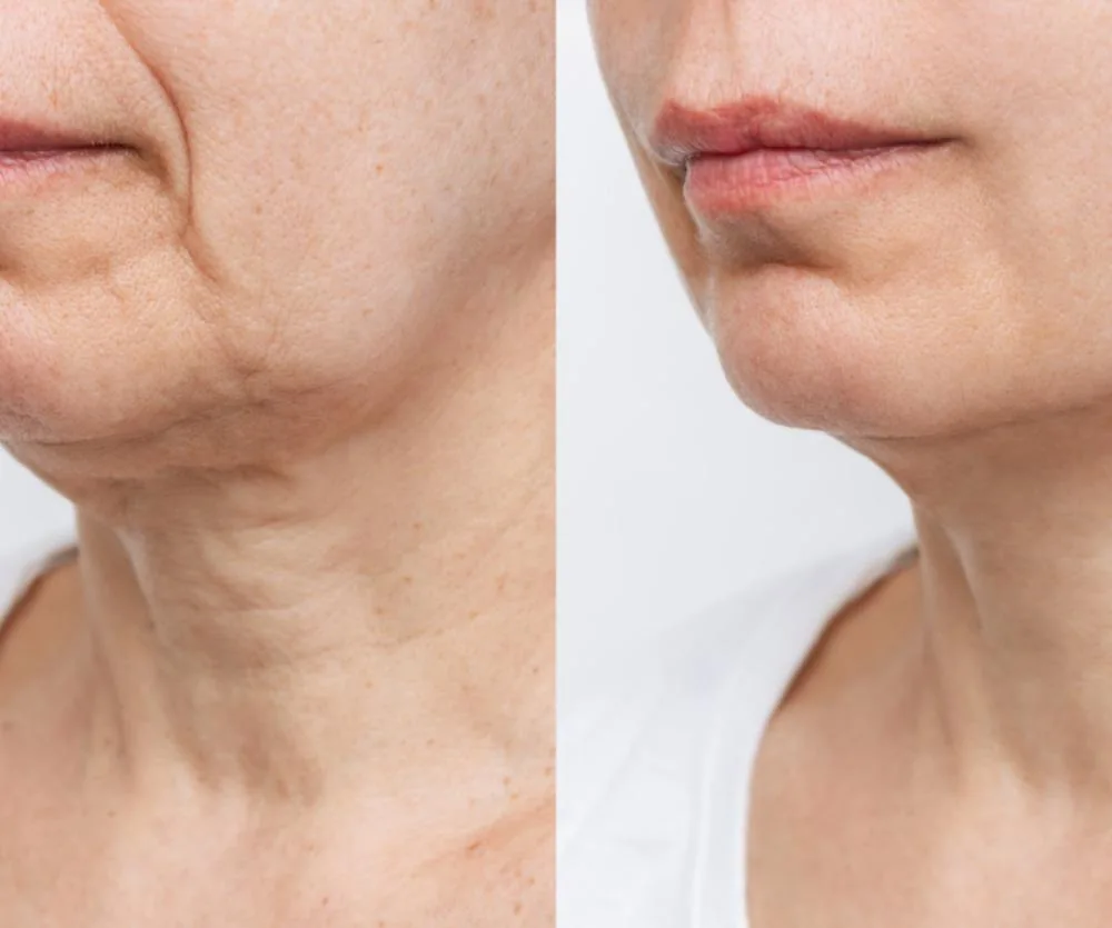 Before and after comparison of a neck lift procedure, showing a close-up of a woman's lower face, jaw, and neck. The left side displays loose, wrinkled skin with visible sagging around the jawline and neck, while the right side shows noticeably tighter,