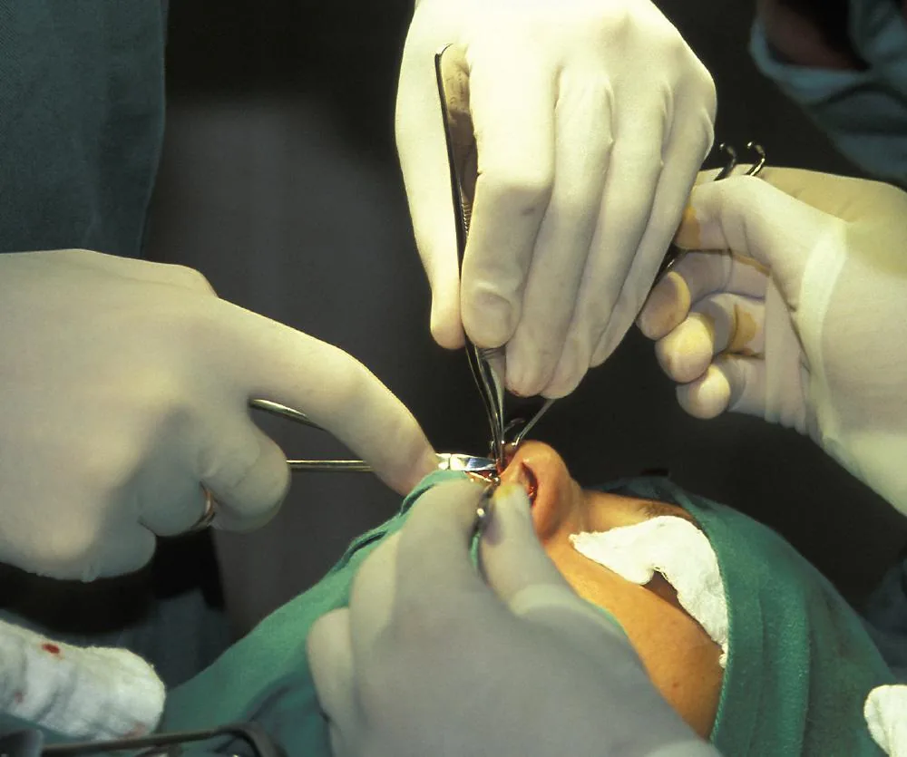 Close-up of surgeons in white latex gloves performing a nasal surgery, likely a septoplasty, on a patient draped in green surgical cloth, using surgical forceps and instruments near the nose.