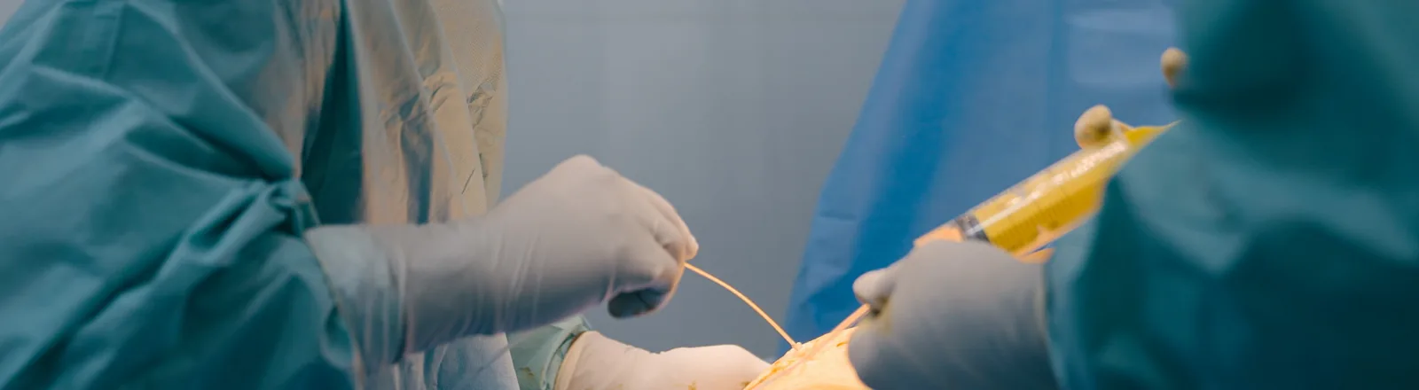 Two surgeons in blue surgical gowns and gloves performing a liposuction procedure, with one holding a thin cannula tube and the other holding a large syringe filled with yellow fluid.